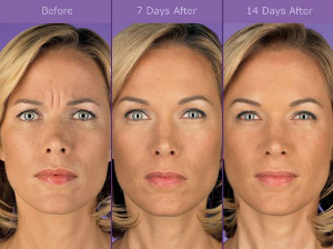 fountain of youth botox